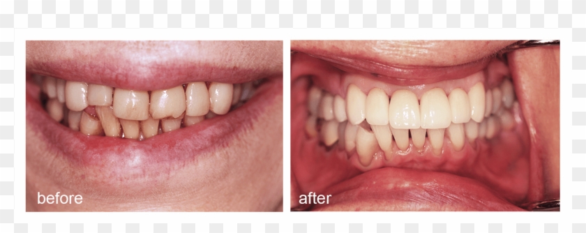 Shot Of Before And After Visiting Abington Smile Gallery - Aggression Clipart