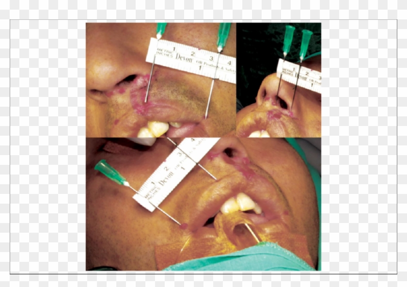 Using Caliper For Cleft Lip Planning - Throat Clipart #1956736