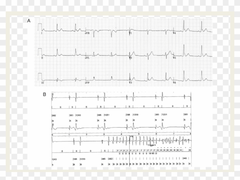 Global J Waves In A Patient Presenting With Electrical - Sheet Music Clipart #1963780