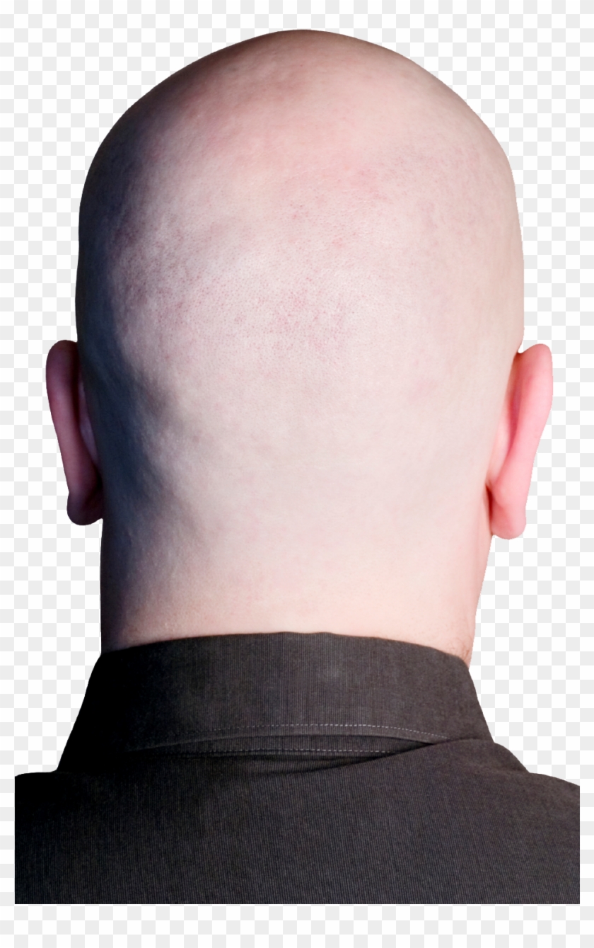 See Original Image Bald Person, Bald Heads, Hair Transplant, - Back Of Bald Head Transparent Clipart