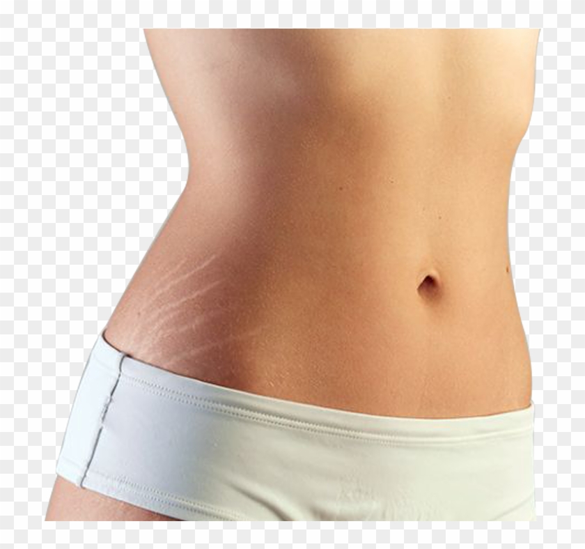 Stretch Marks , Png Download Clipart