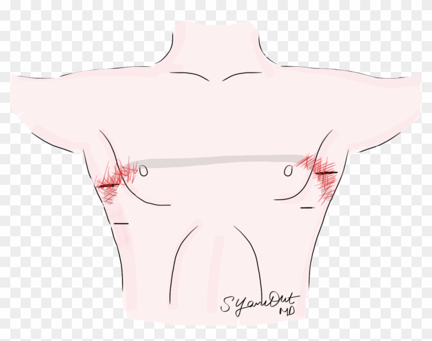 Metal Allergies And The Nuss Bar - Illustration Clipart