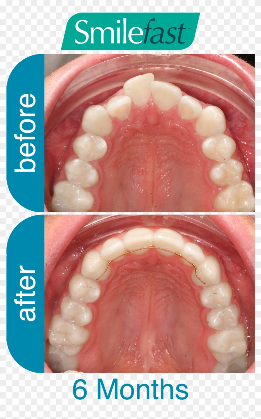 Aqd Smilefast After 6-months - Braces Before And After Buck Tooth Clipart