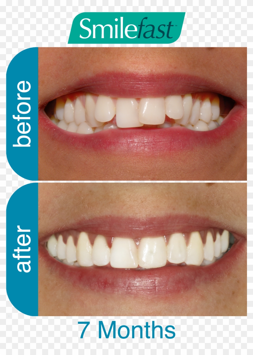 Aqd Smilefast After 7 Months2 Aqd Smilefast After 8 - Braces Before And After 8 Months Clipart #2054766