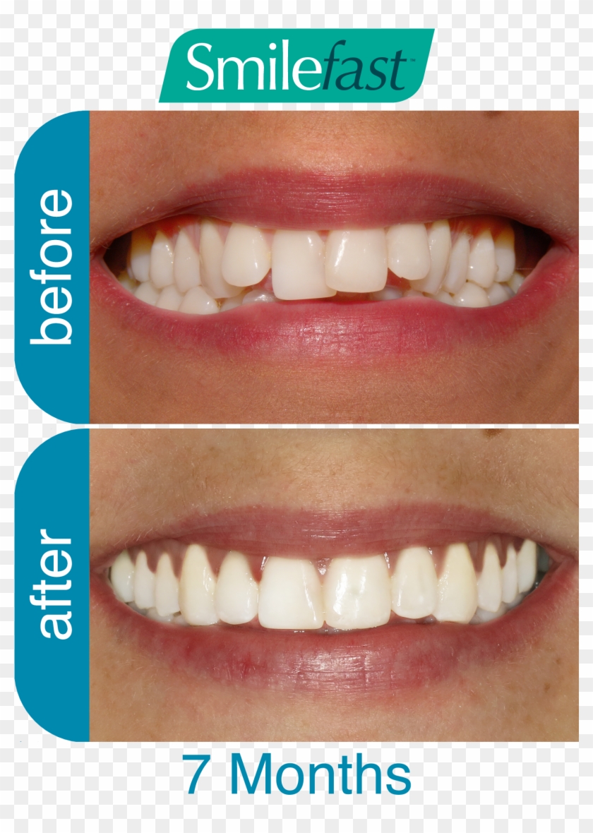 Aqd Smilefast After 7 Months2 Aqd Smilefast After 8 - Braces Before And After 8 Months Clipart