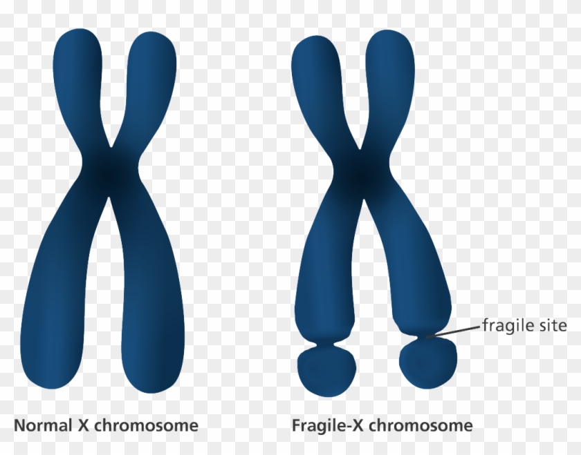 An Illustration Showing The Appearance Of Normal And - Fragile X Syndrome Woman Clipart #2074084