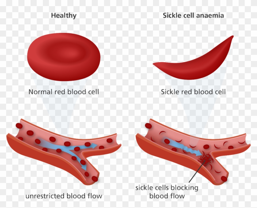 Png Freeuse Library What Is Sickle Anaemia Pinterest - Sickle Cell And Normal Cell Clipart #2074322
