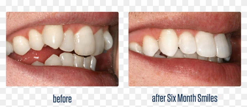 Smile Teeth Png - Straight Smile Clipart