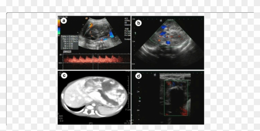 Fetus With Multiple Hemangiomas In The Whole Liver - Computed Tomography Clipart #2160410