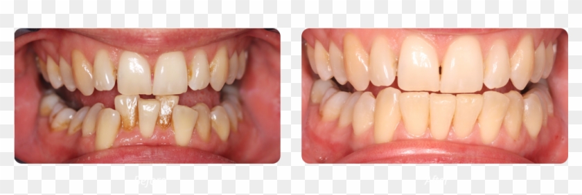 Fast Braces 4 Months - Macro Photography Clipart #2204416