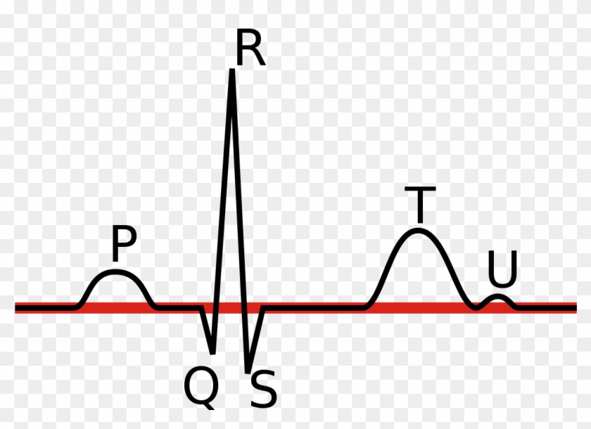 Linia Izoelektryczna Ekg - Ecg Wave Png Clipart