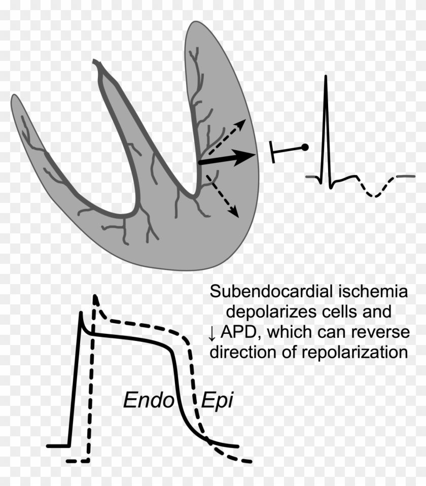 Ecg Ischemic T Wave Inversion - Sinoatrial Node Clipart