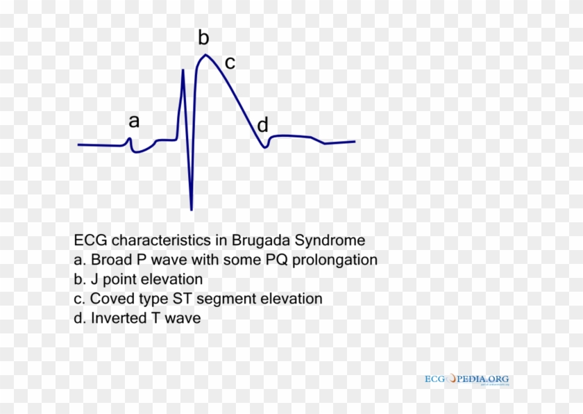 Brugada Ecg Characteristics Clipart #2235727