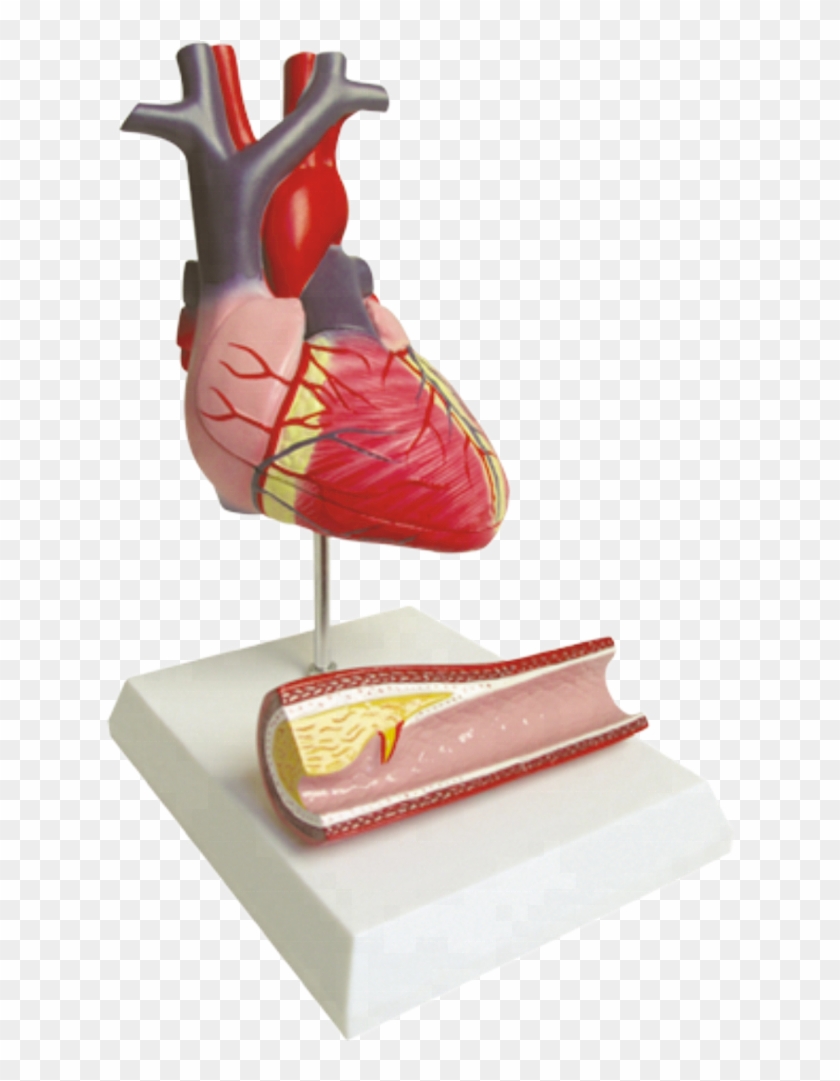 Diseased Heart Model, Diseased Heart Model Suppliers - Figurine Clipart #2270877