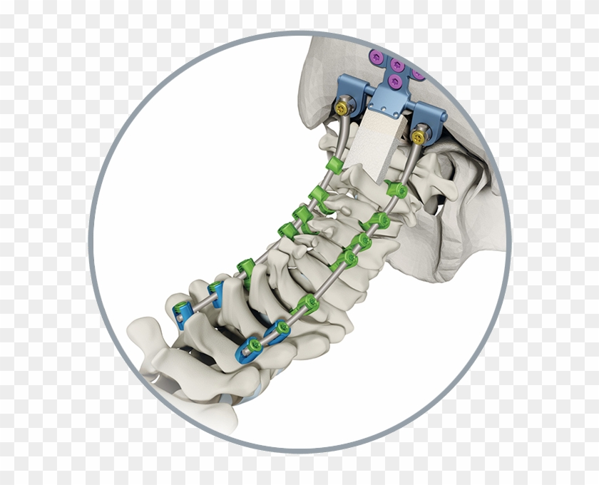 Atec Spine Products Solanas Featured Image - Bone Clipart #247033