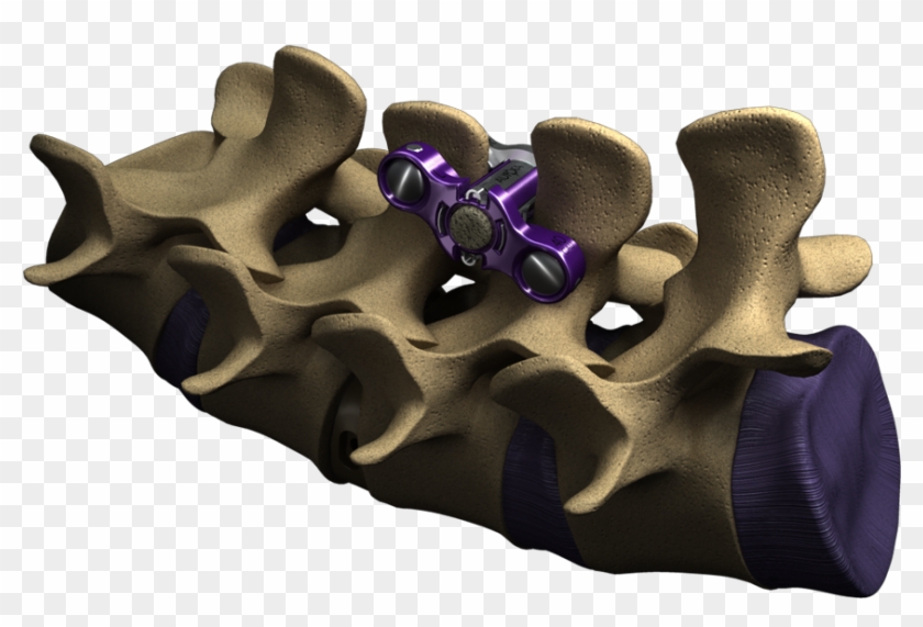 Spine Zipultra-1 - Spinal Fusion Systems Clipart #247256