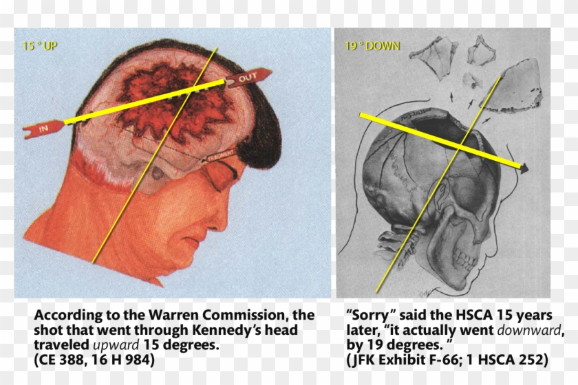 John F Kennedy Autopsy , Png Download - Jfk Assassination Head Shot Clipart