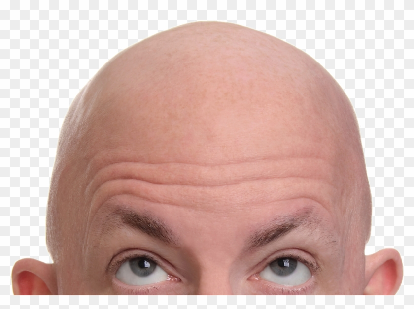 #ftestickers #people #man #head #bald - Baldness Hair Clipart