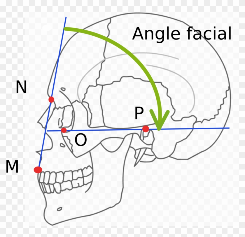 Angle Facial - Lefort 1 Fracture Line Clipart
