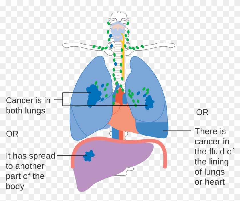 Tnm Staging Lung Cancer , Png Download - Stage 4 Lung Cancer Diagram Clipart #2572058