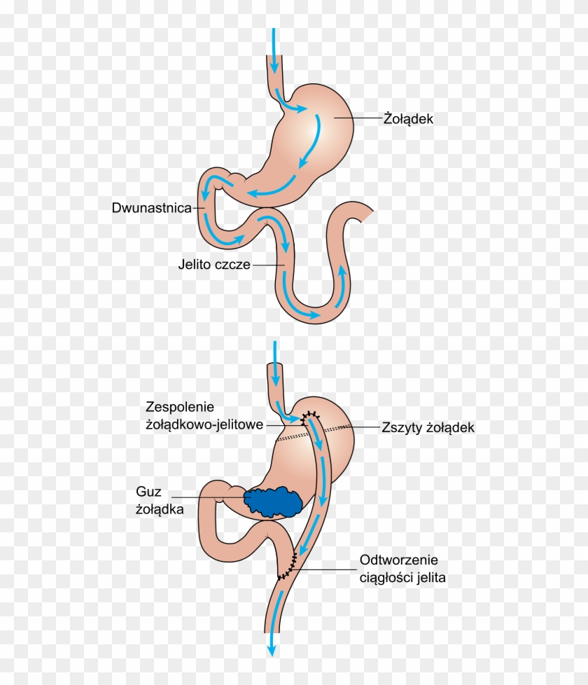 Diagram Showing Before And After Stomach Bypass Surgery Clipart