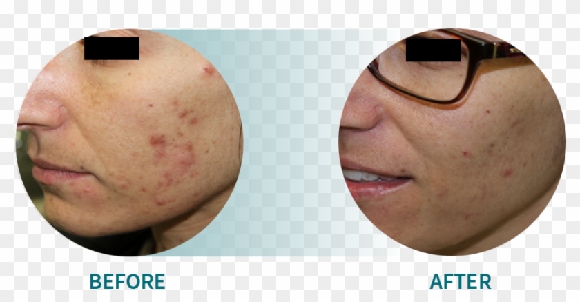 Active Acne/acne Scars - Smile Clipart