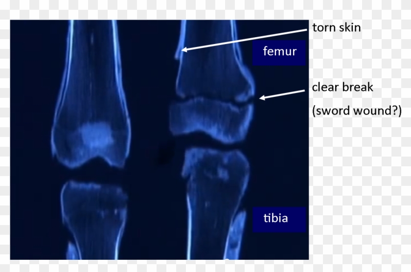 Tut's Leg Bones - King Tut Leg Fracture Clipart