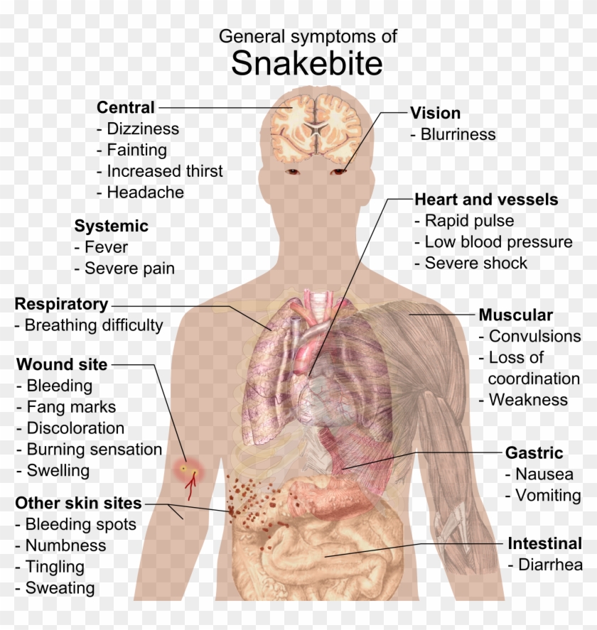 Clipart Black And White Library Datei Bite Symptoms - Infectious Mononucleosis - Png Download