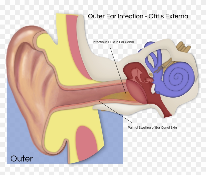 Ear Infection Png - Schwannoma Vestibular Png Clipart #277137