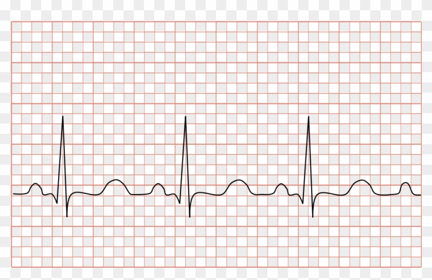 Tachycardia Svg Clipart #2769428