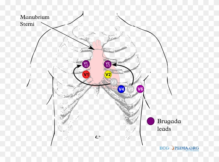 Brugada Lead Placement - Brugada Syndrome Ecg Placement Clipart
