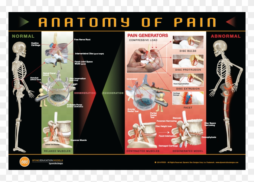Anatomy Of Pain Poster - Disc Herniation Posters Clipart #2780183