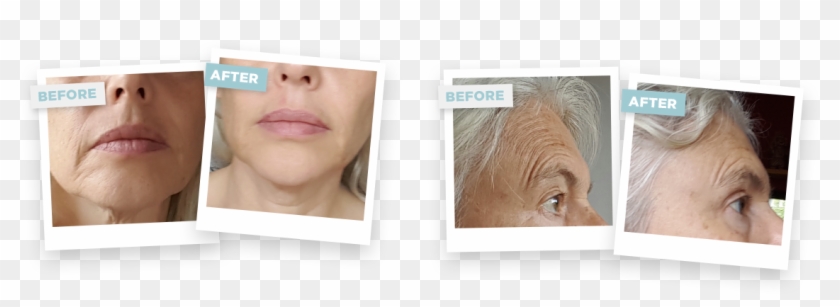 Before Joining Face Yoga Method, Ann-marie Noticed - Horse Clipart