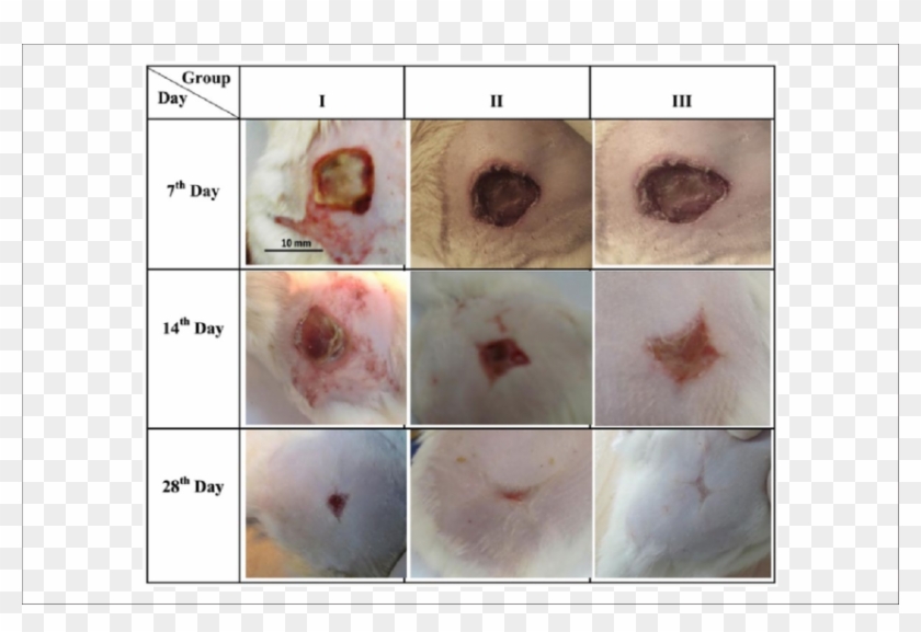 Skin Photographs Of Second-degree Burns Treated With - 10th Degree Burn Clipart