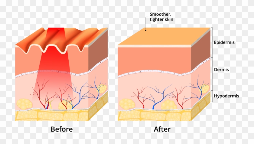 Red Light Therapy Users Have Reported A Noticeable - Microneedling Stretch Marks Diagram Clipart #2860817