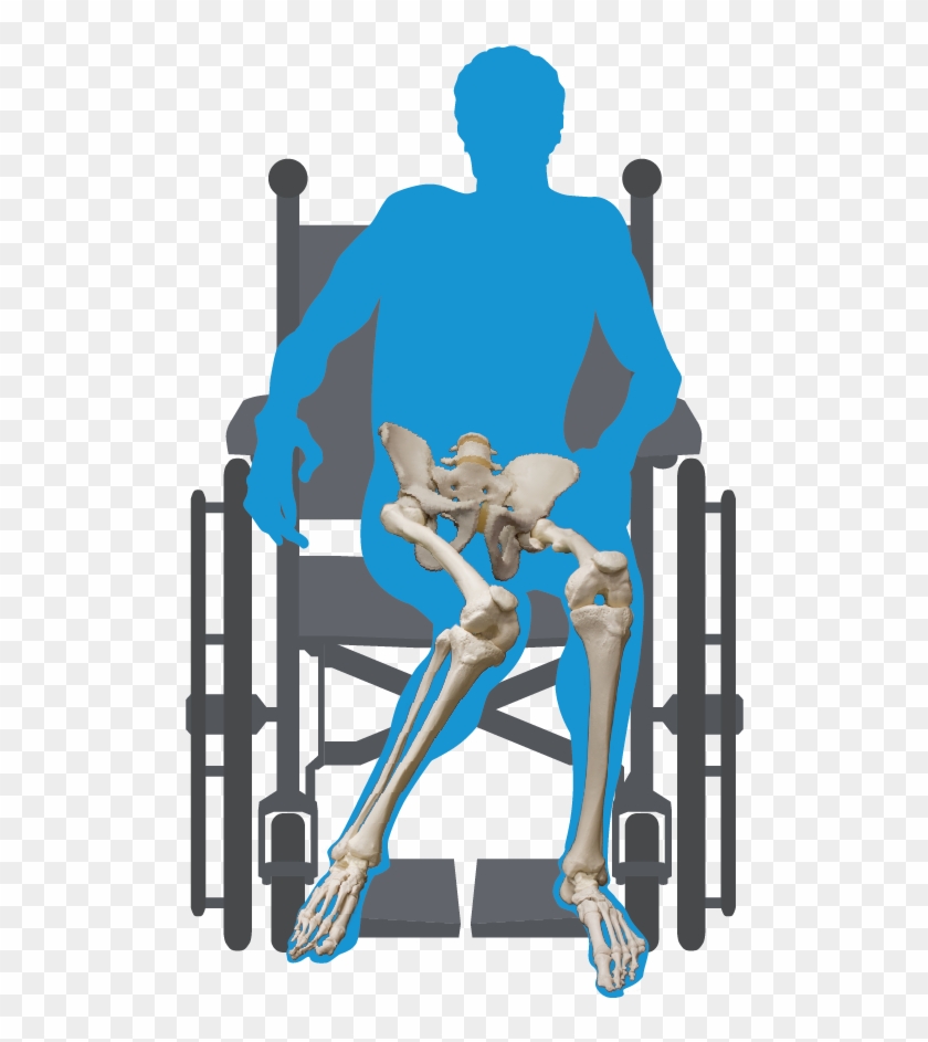 Windswept-deformity - Windswept Deformity Cerebral Palsy Clipart