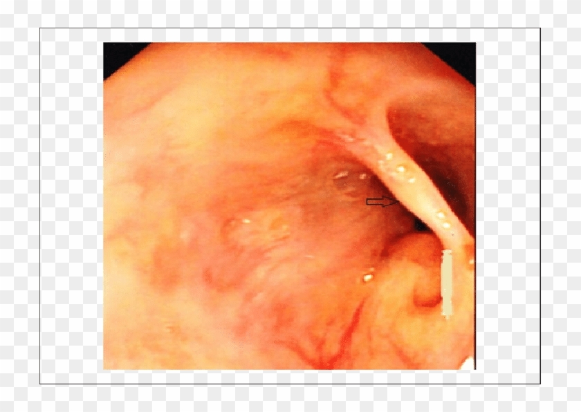 Revealed A Mucosal Bridge Across The Lower Third Of - Painting Clipart #2924836