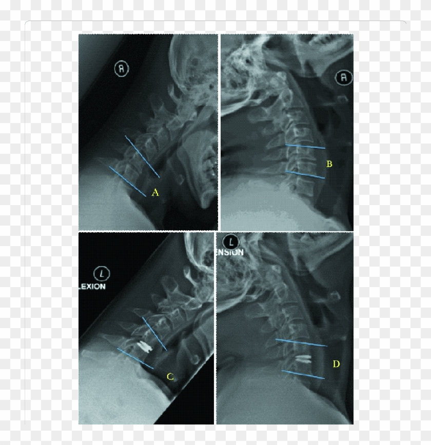 Measurement Of The Functional Spine Unit Angle - Medical Imaging Clipart