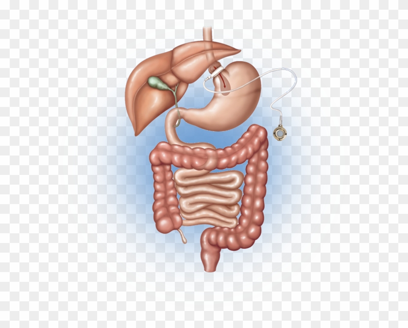 Your Ultimate Goal Of Weight Loss Surgery Is To Live - Vertical Sleeve Gastrectomy Clipart