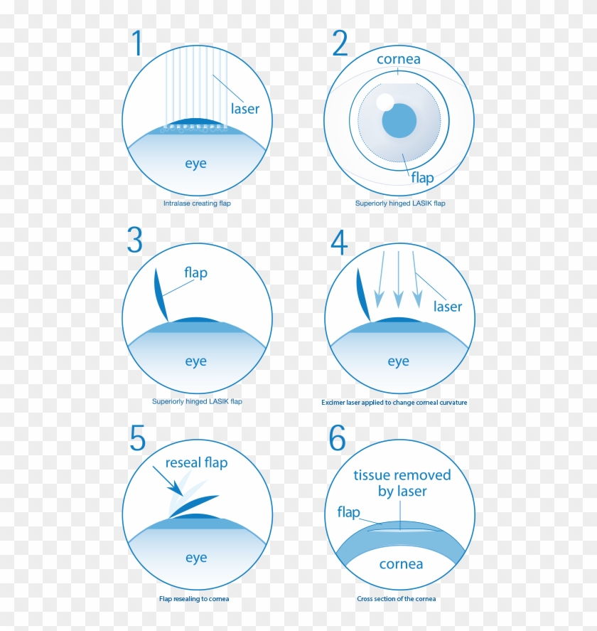 Are You Suitable For Laser Eye Surgery - Does Laser Eye Surgery Work Clipart #305211