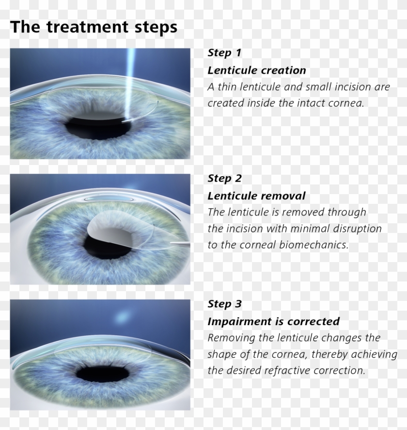 Description Of Treatment Steps With Smile - Lasik Smile Clipart