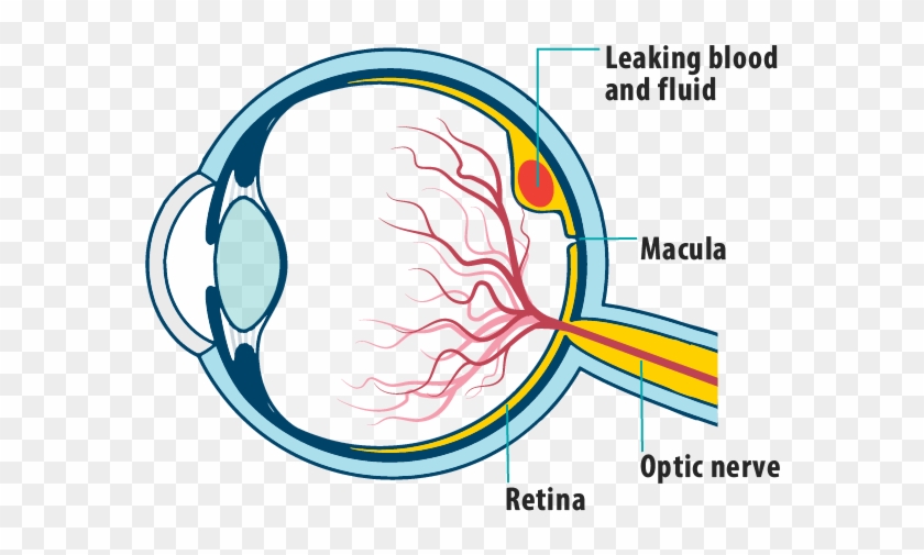 Picture Of Effects Of Wet Amd On The Eye, Showing Leaking - Leaky Blood Vessels In Eyes Clipart