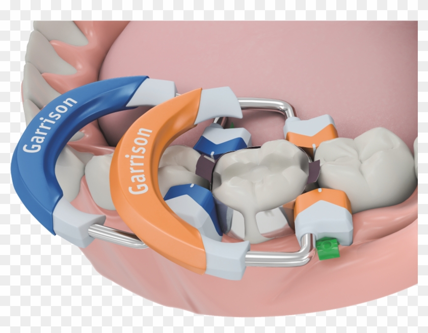 Garrison Dental 3d Fusion Diagram Clipart #3119192