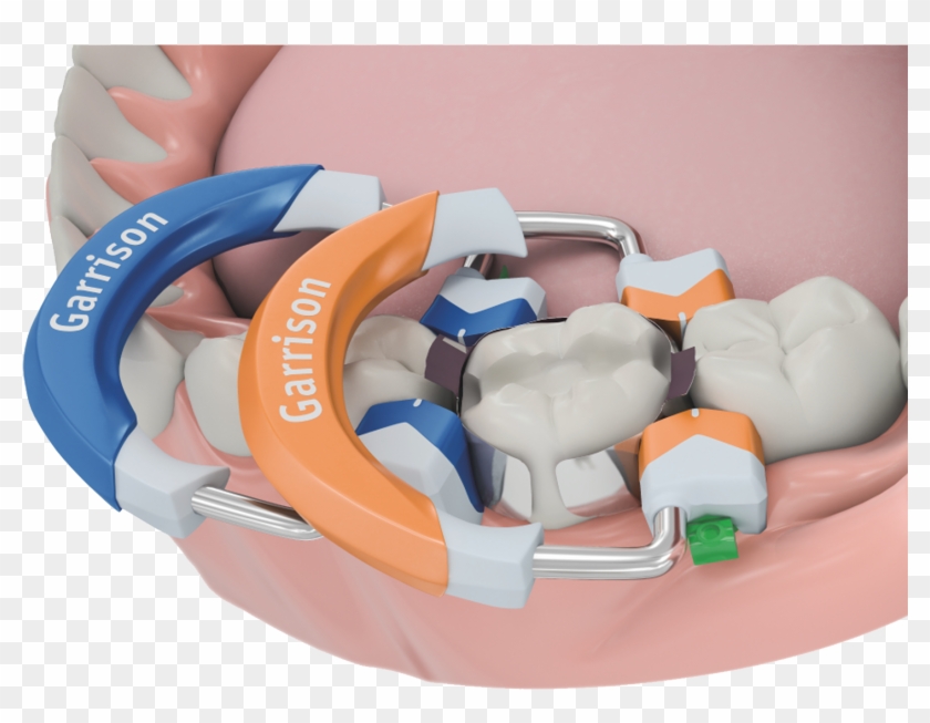 Garrison Dental 3d Fusion Diagram Clipart
