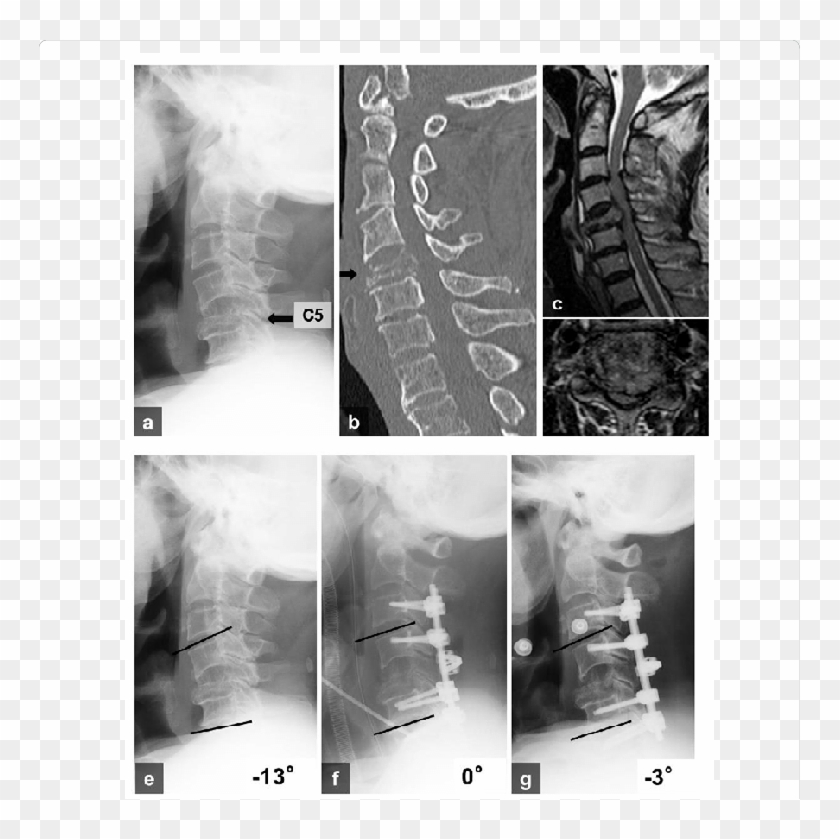 A 75 Year Old Man Who Suffered Metastasis Of Hepatocellular - Monochrome Clipart