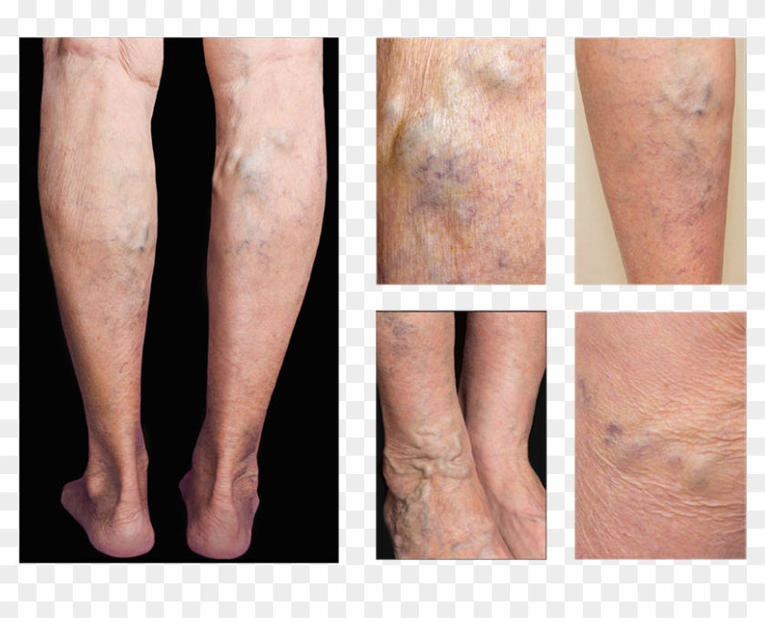 Varicose Veins - Scar Clipart