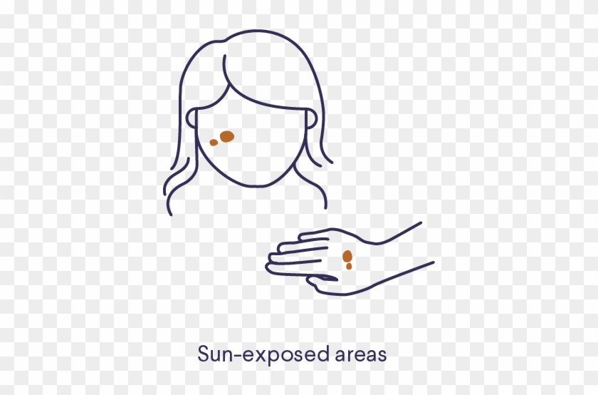 Curology Hyperpigmentation Skin - Drawing Clipart