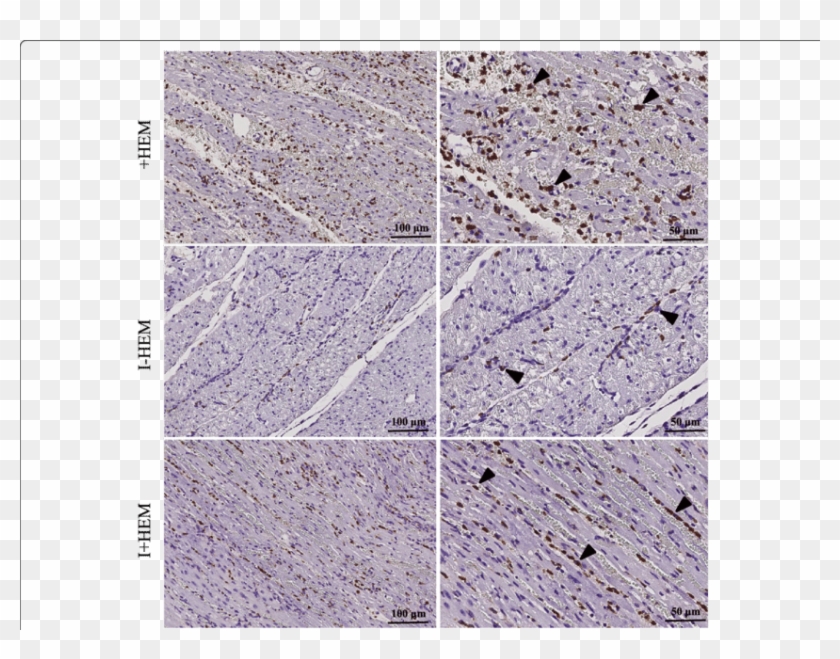 Macrophage Infiltration Was Extensive In Both The Hemorrhagic - Tile Clipart