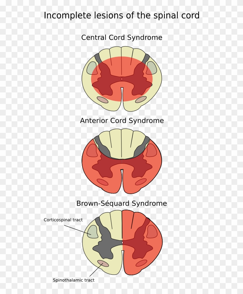 Anterior Spinal Artery Syndrome - Anterior Spinal Syndrome Clipart #3233964