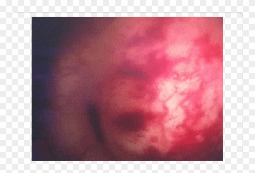 Cystoscopy Showing An External Bulge In The Urinary - Visual Arts Clipart